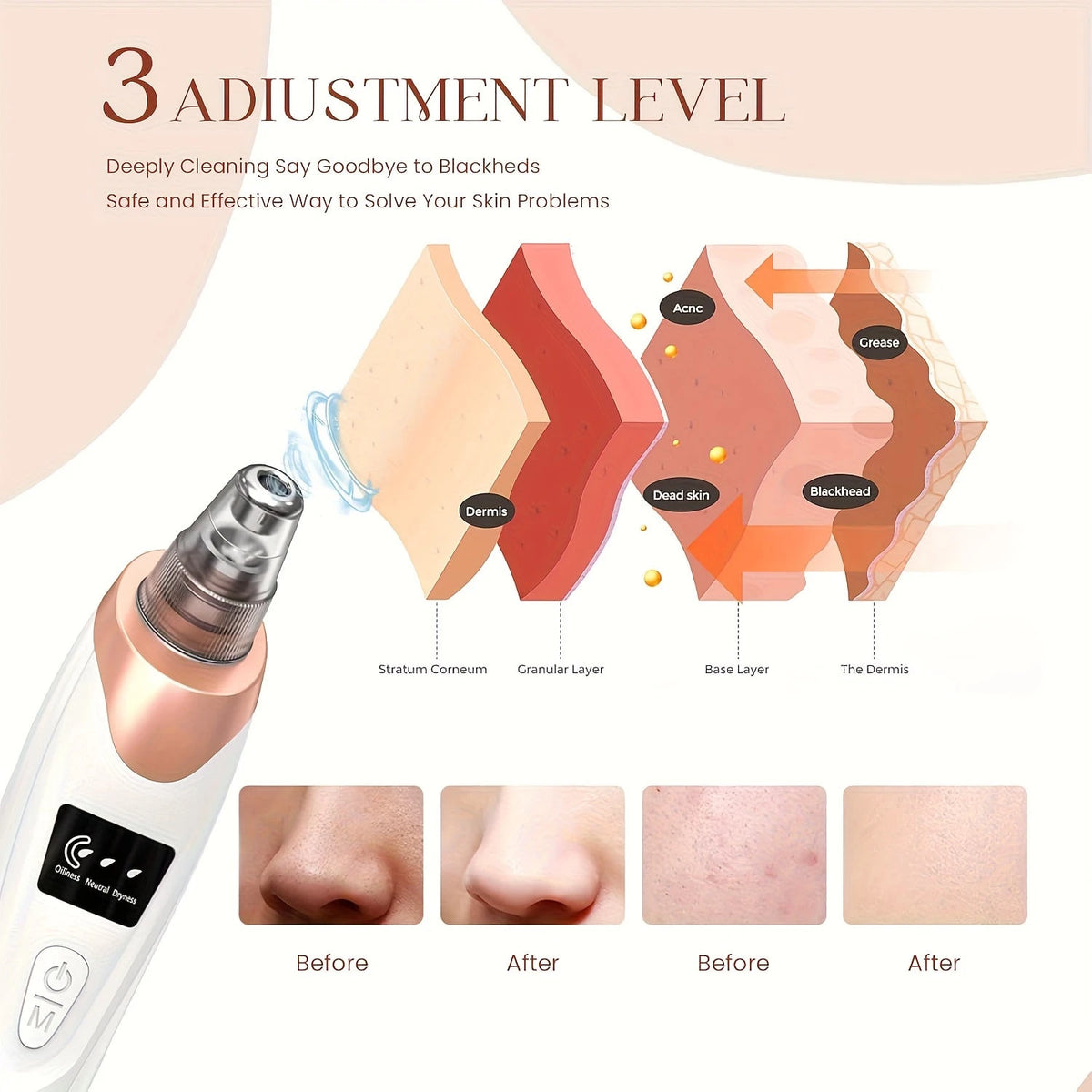 Electric Blackhead Remover, USB Charging, 5 Suction Tips And 3 Adjustable Gears, Electric Acne Removal Tool, Suitable For Both Women And Men, As A Gift For Women